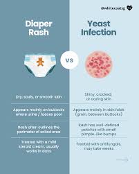 Image result for diaper dermatitis
