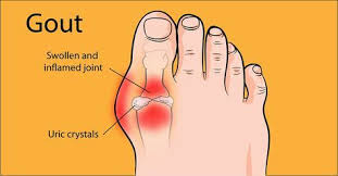 It All Starts With A Little Bit Of Swelling In The Wrist Or Ankles Hands Or Feet Sometimes It Comes On St Gout Remedies Foot Remedies Home Remedies For Gout