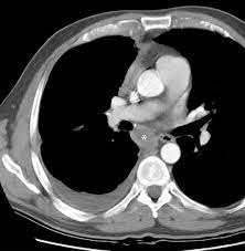 A diagnostic ct scan offers better odds of detecting a mesothelioma tumor as early as possible. Figure 3 From Malignant Pleural Mesothelioma Role Of Ct Mri And Pet Ct In Staging Evaluation And Treatment Considerations Semantic Scholar