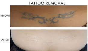 The answer for both is a lot. Tattoo Removal Vanish Method Picosure Laser Tattoo Removal Nyc