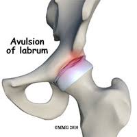 Image result for Hip Labral Tear