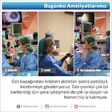 Goz Kapagindaki Kitleleri Aldiktan Sonra Patolojik Incelemeye Gonderiyoruz Goz Cevresi Cok Iyi Kanlandigi Icin Yara Iyilesmesi De Cok Iyi Oluyor V Bilgi Gozler