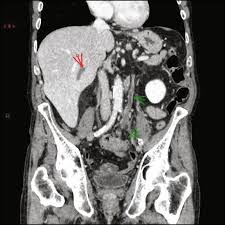 Current Knowledge In Pathophysiology And Management Of Budd Chiari Syndrome And Non Cirrhotic Non Tumoral Splanchnic Vein Thrombosis Journal Of Hepatology