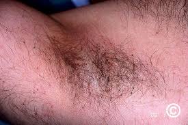 Image result for pubic lice symptoms