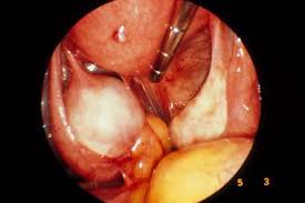 Multiple sonographic images of the pelvis were assessed for gray scale appearance and color doppler flow. Understanding Pelvic Ultrasound Reports Gponline
