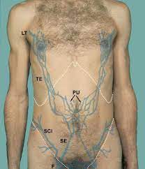 Varicocele is engorgement of the pampiniform plexus that produces a scrotal mass palpable as a bag of worms. formation is usually on the left side due to. Skeleton And Walls Of Abdomen