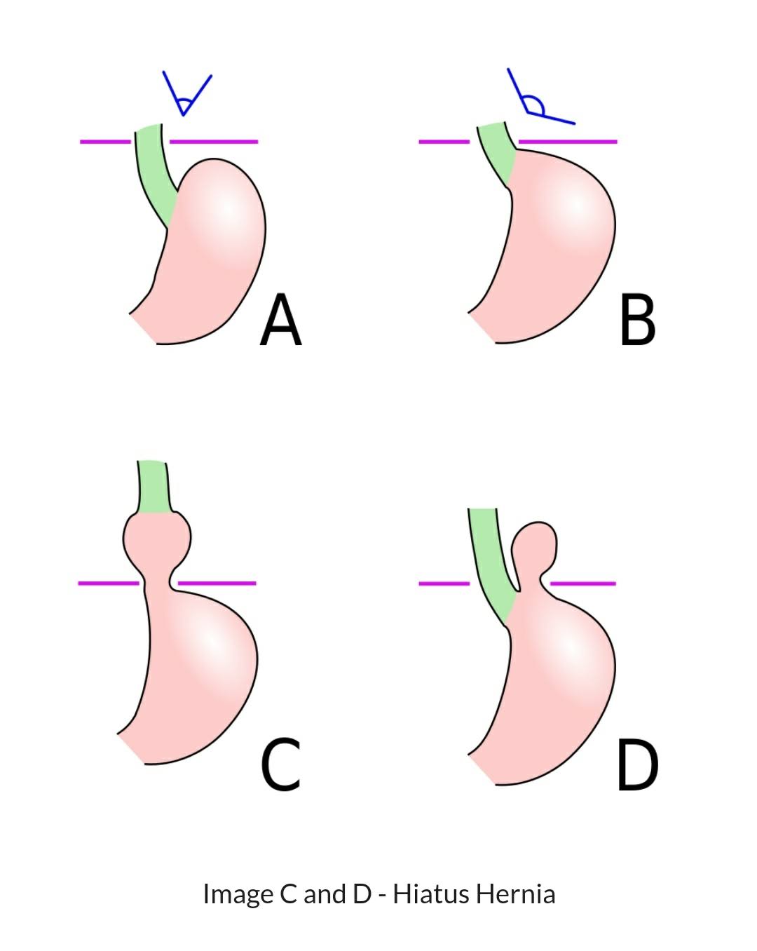 Surgery for Hiatus hernia and GERD