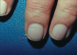 This is a medical term for kidney disease that requires dialysis or kidney transplant for a patient to stay alive. Terry S Nails Causes Differential Diagnosis Treatment