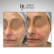 👉🏼 Relleno del surco Del Valle lagrimal (relleno de ojera) más relleno en  arruga del surco nasogeniano 🙌🏻 Procedimiento ambulatorio con efectos  inmediatos realizados con ácido hialurónico👌 además de rellenar el surco