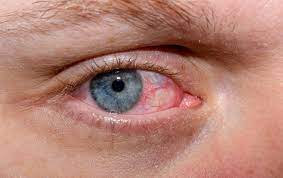 Dry Eye Disease: Causes, Symptoms, and Effective Treatments ...