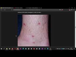 Boutons qui grattent sur le pubis : Boutons Qui Demangent Bouton Rouge Qui Gratte Les Causes Que Faire Youtube