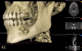 Periapical cemental dysplasia(pcd) is a condition most commonly seen in the mandibular incisor region. Cemento Osseous Dysplasia Of The Jaw Bone Cemento Osseous Dysplasia Of The Jaw Bone Kazemi Oral Surgery Facialart Com