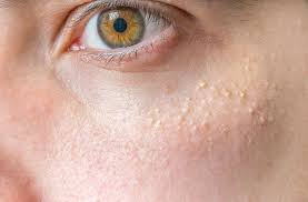 Image result for milium cyst on eyelid