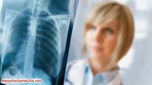The type of mesothelioma that a person has is often referred to as the cell type or histological type. it is estimated that up to 20% of mesotheliomas are of the sarcomatoid type. Bap1 Sarcomatoid Mesothelioma Malignant Sarcomatoid Mesothelioma Youtube