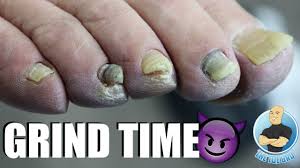 grinding down thick damaged toenails