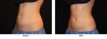 Pin On Coolsculpting