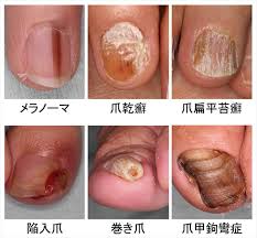 爪外来 皮膚科 Kompas
