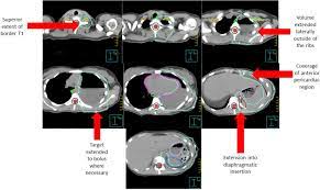 mesothelioma is a cancer that affects the thin membrane protecting several of the body&#x27;s most important organs, including the lungs, abdomen and heart. The Use Of Radiation Therapy For The Treatment Of Malignant Pleural Mesothelioma Expert Opinion From The National Cancer Institute Thoracic Malignancy Steering Committee International Association For The Study Of Lung Cancer And