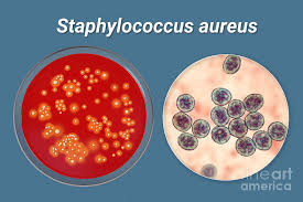 Image result for Staphylococcus Aureus