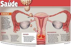 O hpv, vírus transmitido principalmente através de relações sexuais desprotegidas, está associado a diversos tipos de câncer, como de colo de o que é hpv? Cientistas Desenvolvem Metodo De Autoteste Para O Cancer Cervical