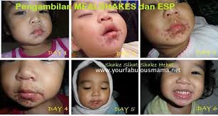 Penyakit hfmd disebabkan oleh virus yang dikenali sebagai enterovirus meliputi coxsackie virus a16 (cox a16) dan enterovirus 71 (ev 71). Penyakit Tangan Kaki Dan Mulut Hfmd Punca Dilemma Si Ibu Beranak Kecil
