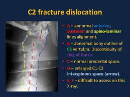 It is important that lines 1 and 2 are traced to the superior aspect of spinous processes should lie in a straight line, except if they are bifid. Part 4 0 Standardised Interpretation Of Paediatric Cervical