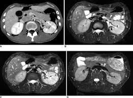 Nutcracker Syndrome In 24 Year Old Man A Contrast Enhanced Ct Scan Download Scientific Diagram