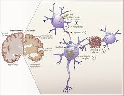 Failure to protect and enforce biogen's data, intellectual property, and other proprietary rights and uncertainties relating to intellectual property claims and challenges. Aging Down Syndrome And Alzheimer Apos S Disease Common Molecular Traits Beyond The Amyloid Precursor Protein Full Text