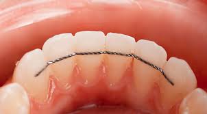 L'orthodontie chez les adultes– COE