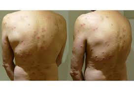 Image result for mite bites on humans