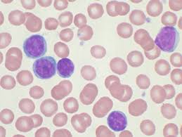 Cll Neues Verfahren Knackt Tarnkappe Von Blutkrebszellen Healthcare In Europe Com