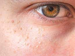 See full list on wikihow.com How To Get Rid Of Milia Is Home Removal Safe
