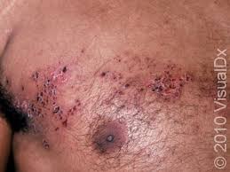 Image result for Varicella zoster on human skin