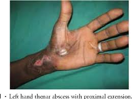 Your body sends a flood of chemicals into your bloodstream to fight the threat. Figure 1 From Hand Sepsis In Patients With Diabetes Mellitus Semantic Scholar