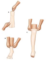 Patient Education Edema Swelling Beyond The Basics Uptodate