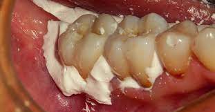 See our picks for the best 10 crown cements in uk. Dental Cement Temporary Cementation And Permanent Cementation