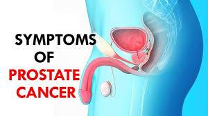 Early prostate cancer usually causes no symptoms. Signs Of Prostate Cancer Symptoms Of Prostate Cancer