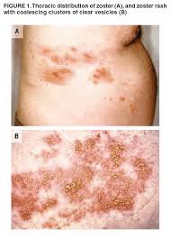 Many years later, usually after age 60, an outbreak may. Prevention Of Herpes Zoster Recommendations Of The Advisory Committee On Immunization Practices Acip