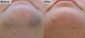 Wide choice of solutions for everyone. Best Affordable Laser Hair Removal Blue Venus Plastic Surgery Raipur