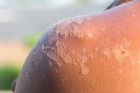 Image result for Sunburn