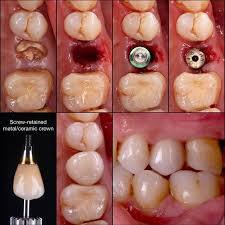 Immediat Implant Placement After The Extraction Hopeless Second Premolar Screw Retained Metal Dental Aesthetics Dental Reconstruction Dental Implant Procedure