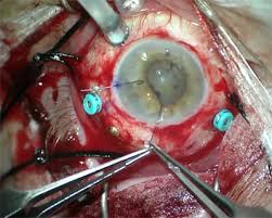We did not find results for: Pvr And Retinal Detachment Repair American Academy Of Ophthalmology