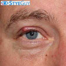 As with many cancers, sebaceous gland cancer can be. Eye Stye Photos Eyelid Lesions Eyelid Skin Cancer The Styeguy