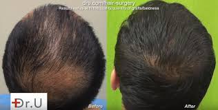 You can find cheaper, but please do your research and don't let any cowboy surgeons near your face. Beard Hair Transplant Cost Dermhair Clinic L A 1 310 318 1500