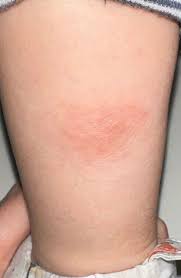 Image result for Eczema nummulare