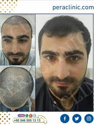 Hair Transplant Sac Hayaller