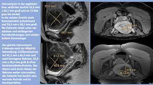Radiologie Dux Gebarmuttermyome Ursachen Risiken Und Behandlung