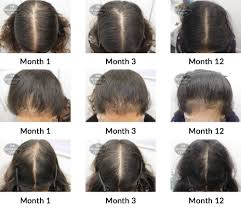 A quick youtube search will supply you with all the testimonials you need. Hair Growth Success Story My Treatment Has Been Life Changing I Now Feel Confident