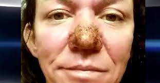 Rhinophym ist eine eher seltene erkrankung, die besonders bei personen mit unbehandelter rosacea oder rosazea im fortgeschrittenen stadium beobachtet wird. Frau Mit Seltener Hauterkrankung Bekommt Neue Nase Geschenkt