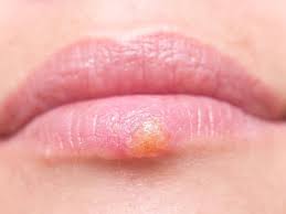 On the other hand, hsv type 2 causes the infection that involves genitals, buttocks and the lower back. Natural Herpes Treatment Lifeworks Wellness Center